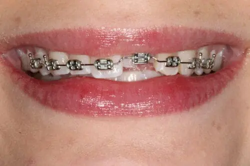 before dentistry at Flax Dental