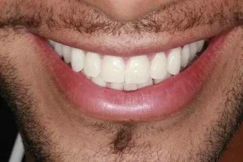 after dentistry at Flax Dental