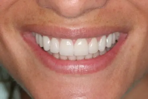 after dentistry at Flax Dental