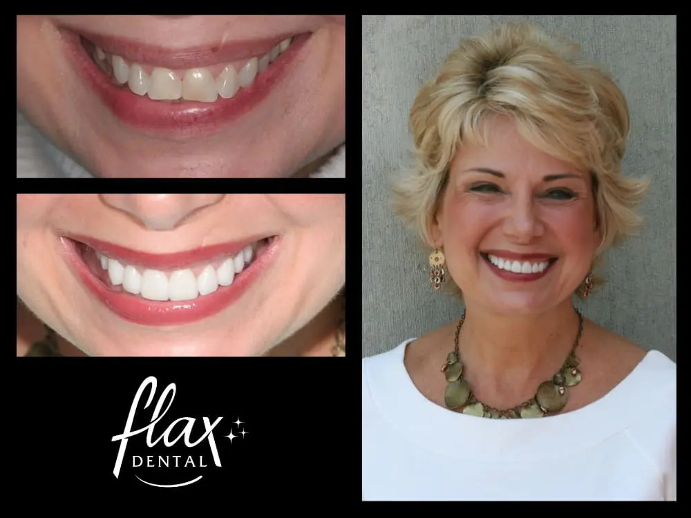 Smile Makeovers in Atlanta GA